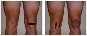 Figure Difference in the clinical presentations of anterior knee pain in the study. Far left is the site of pain for the group diagnosed with ‘patellar tendon pain’ and all other presentations make up the group with ‘other forms of anterior knee pain’