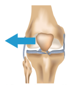 what causes knee cap to move