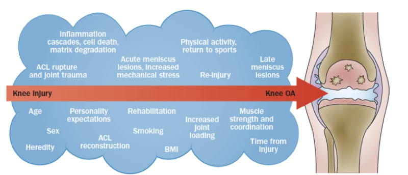 OA after ACL reconstruction: What to say to patients - La Trobe Sport ...